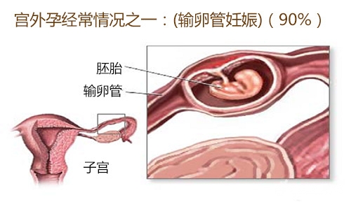 当心受孕后被诊断为宫外孕？别怕，美国试管婴儿助你健康生育