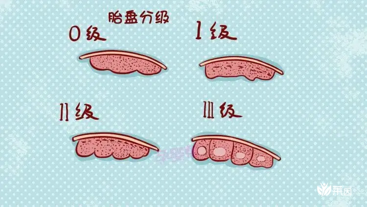 胎盘成熟度级别是什么意思